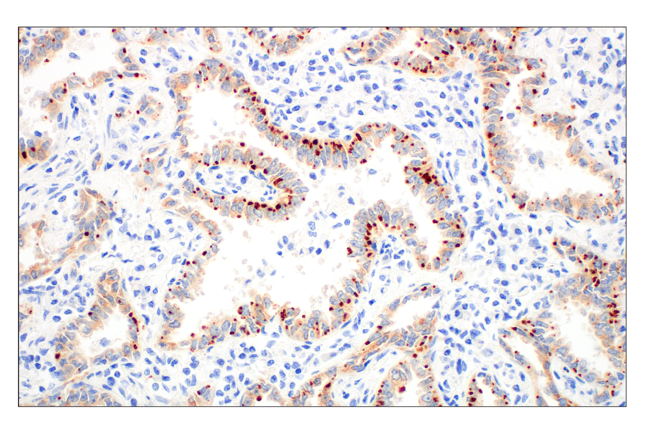 Immunohistochemistry Image 3: ROS1 (D4D6®) Rabbit mAb