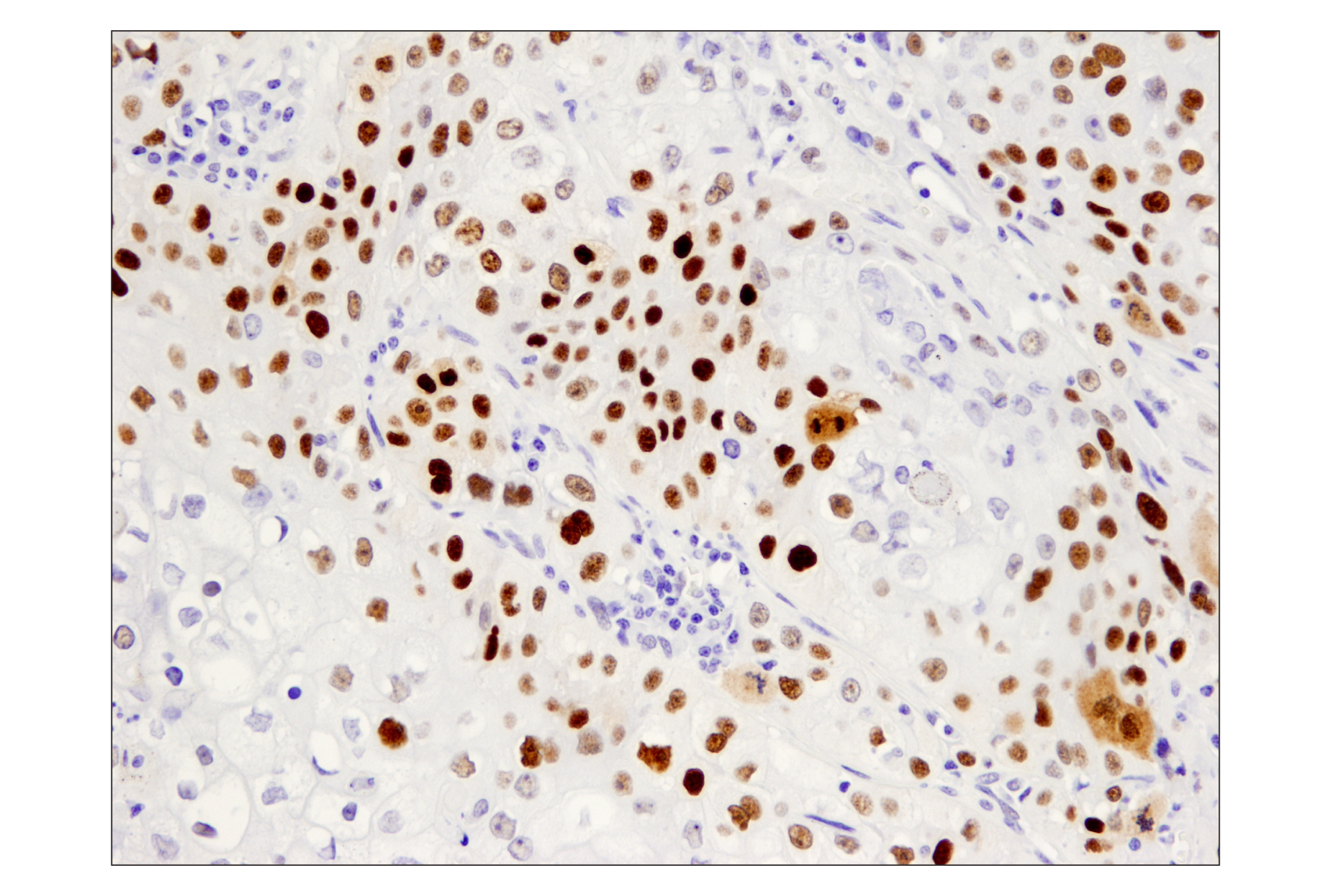 Immunohistochemistry Image 3: p53 (DO-7) Mouse mAb