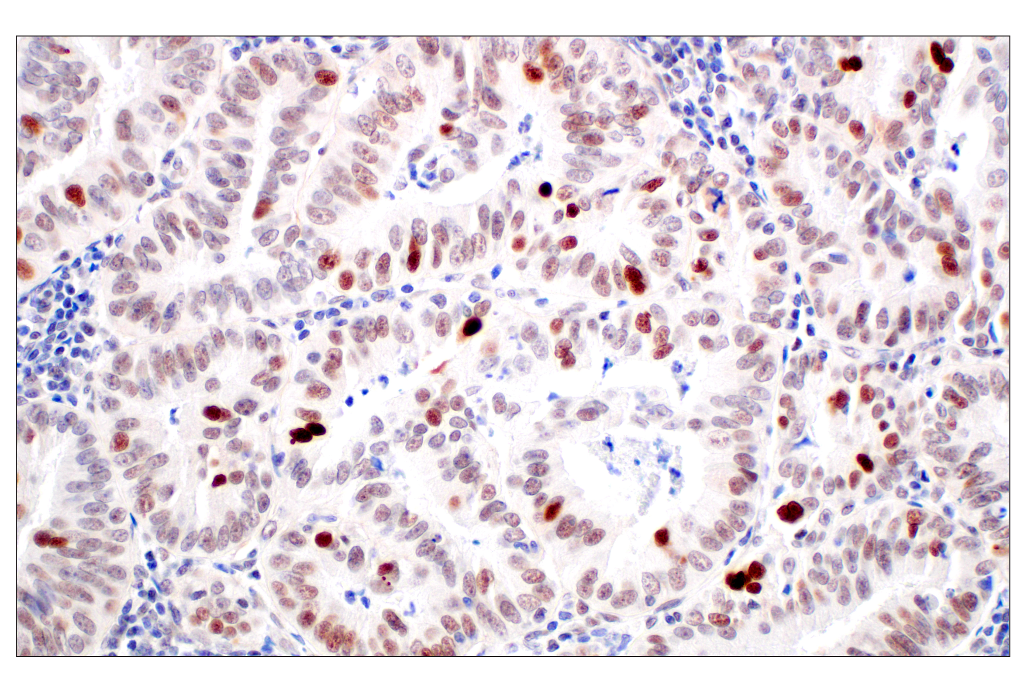 Immunohistochemistry Image 1: MDM2 (F7W7X) Rabbit mAb (BSA and Azide Free)