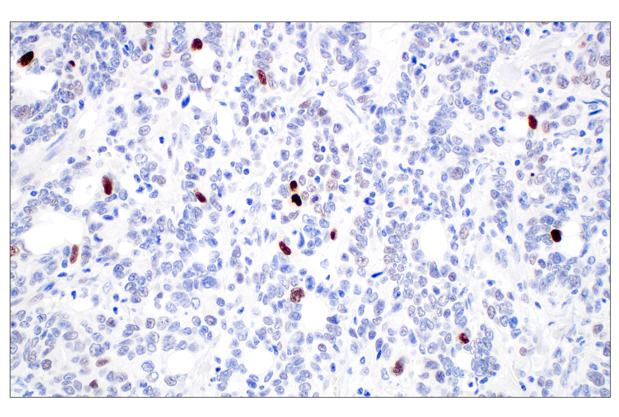 Immunohistochemistry Image 4: MDM2 (F7W7X) Rabbit mAb (BSA and Azide Free)
