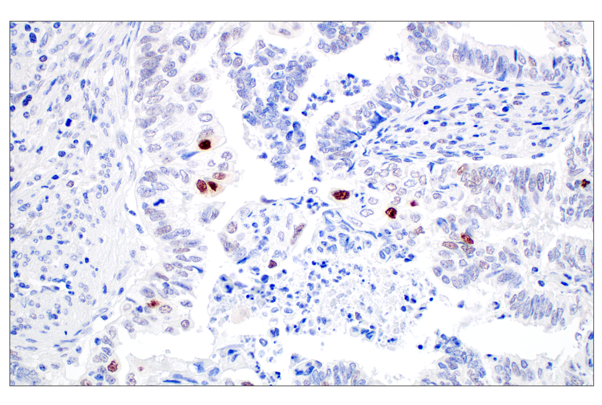 Immunohistochemistry Image 3: MDM2 (F7W7X) Rabbit mAb (BSA and Azide Free)