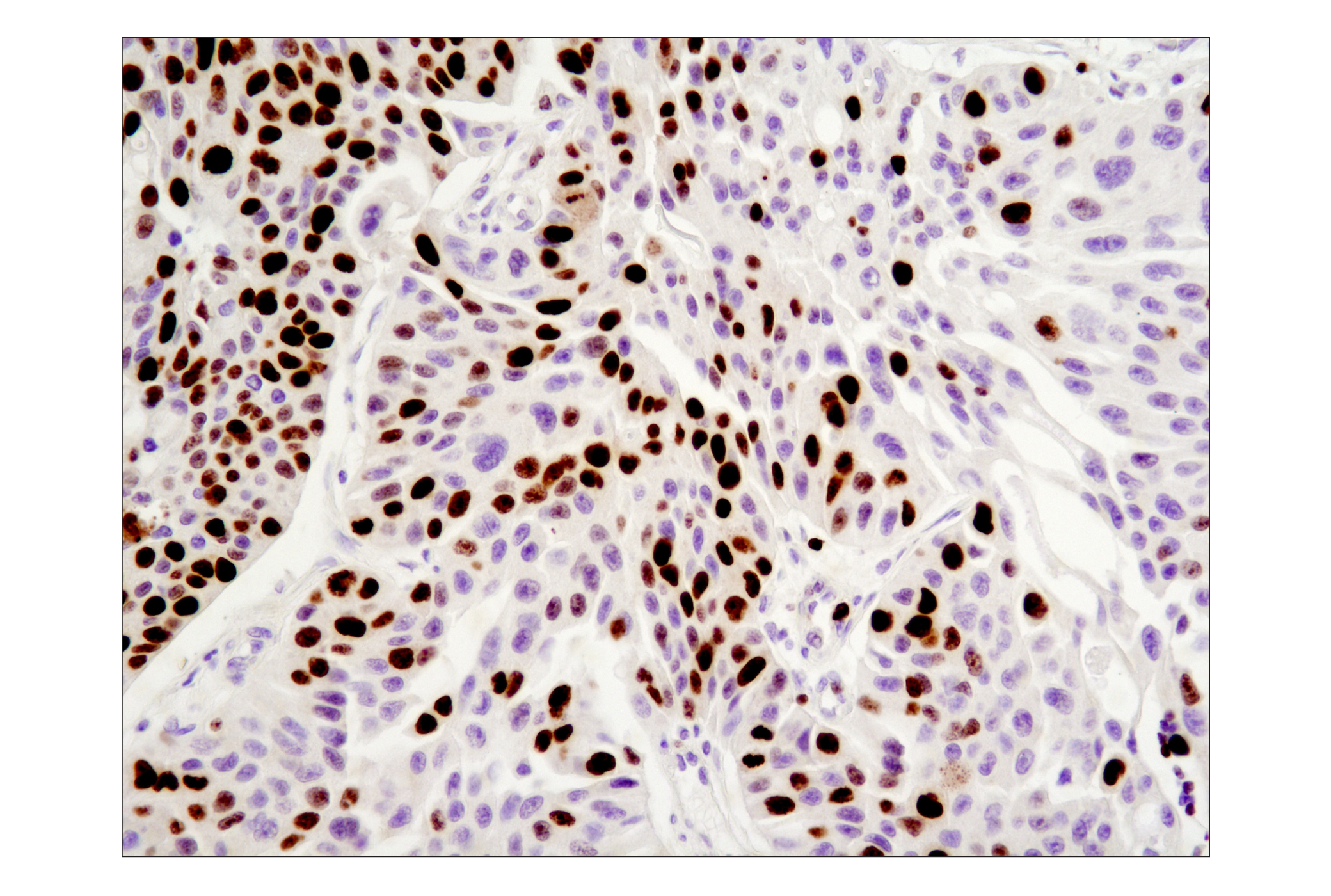 Immunohistochemistry Image 2: Ki-67 (8D5) Mouse mAb (BSA and Azide Free)