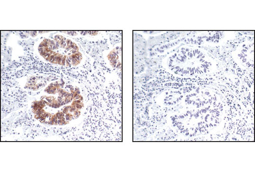 Immunohistochemistry Image 3: Phospho-HER2/ErbB2 (Tyr1221/1222) (6B12) Rabbit mAb (BSA and Azide Free)