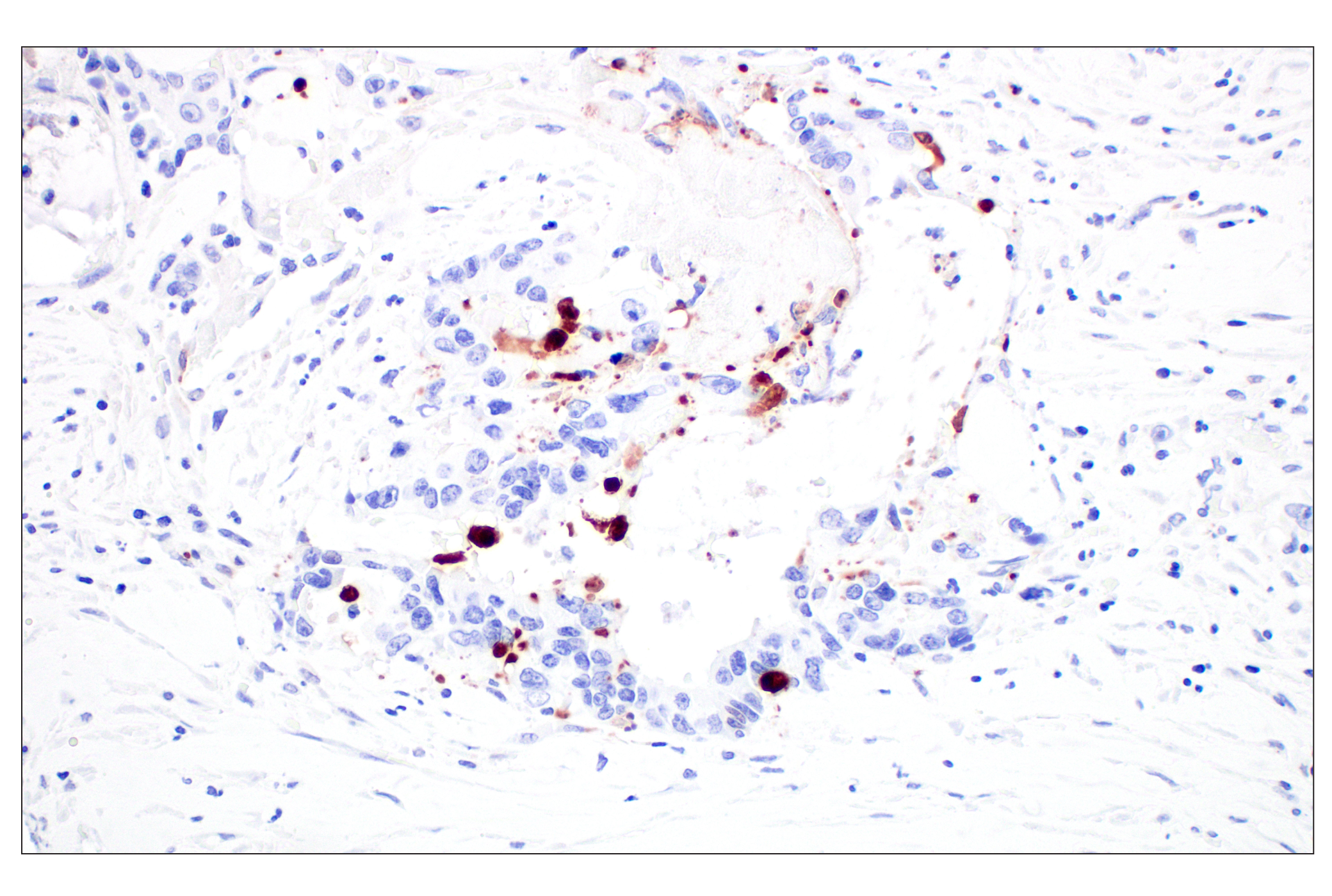 Immunohistochemistry Image 4: Cleaved Caspase-3 (Asp175) (D3E9) Rabbit mAb