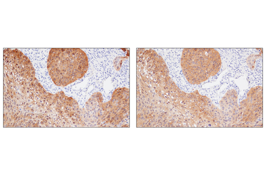 IHC analysis of paraffin-embedded human squamous cell lung carcinoma using MAGE-A4 (E7O1U) (upper) or MAGE-A4 Antibody (lower). These two antibodies detect independent, unique epitopes on human MAGE-A4. The similar staining patterns obtained with both antibodies help to confirm the specificity of the staining.