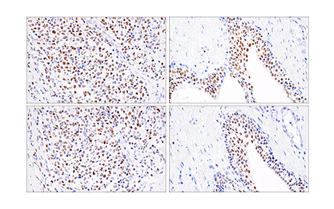 パラフィン包埋ヒトB細胞ホジキンリンパ腫 (左) または前立腺がん (右) を、Helios (E4L5U) (上) またはHelios Antibody (下) を用いてIHCで解析しました。これら2つの抗体は、ヒトHelios上の独立した独特のエピトープを検出します。両方の抗体で得られた染色のパターンが類似しており、これが染色の特異性を確認するのに役立ちます。