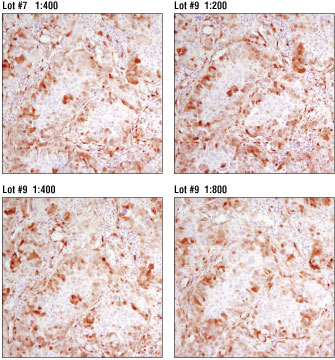 IHC analysis of adjacent sections of paraffin-embedded human colon carcinoma