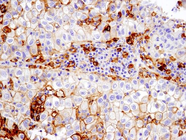 PD-L1 13684 non small cell lung carcinoma