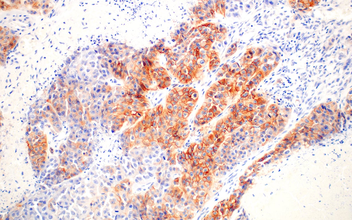 Immunohistochemistry Image 1: EGF Receptor (D38B1) Rabbit Monoclonal Antibody (BSA and Azide Free)