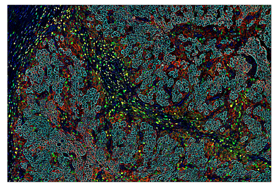 Immunohistochemistry Image 6: PD-L1 (E1L3N<sup>®</sup>) & CO-0005-647 SignalStar<sup>™</sup> Oligo-Antibody Pair