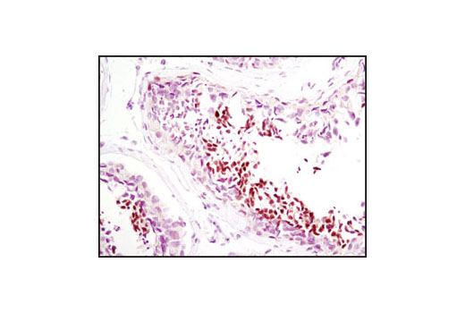 Immunohistochemistry Image 1: NUT (C52B1) Rabbit Monoclonal Antibody (BSA and Azide Free)