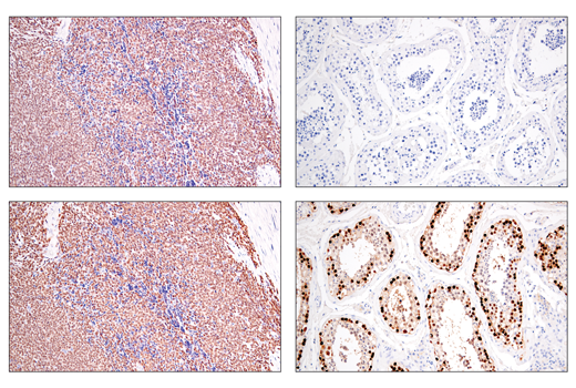 Immunohistochemistry Image 2: SS18-SSX (E9X9V) Rabbit Monoclonal Antibody (BSA and Azide Free)