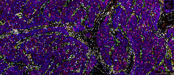 SignalStar multiplex immunohistochemical analysis of paraffin-embedded human colorectal adenocarcinoma.