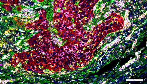 SignalStar multiplex immunohistochemical analysis of squamous cell lung carcinoma in FFPE tissue. 