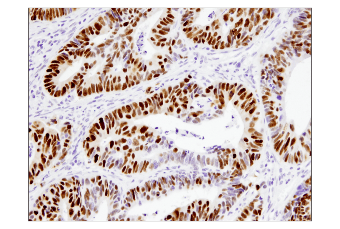Immunohistochemistry Image 2: p53 (DO-7) Mouse Monoclonal Antibody