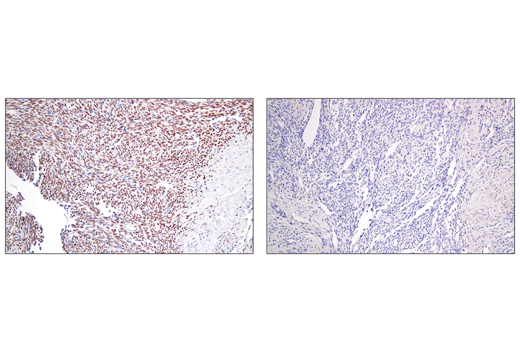 Immunohistochemistry Image 3: SS18-SSX (E9X9V) XP<sup>®</sup> Rabbit mAb