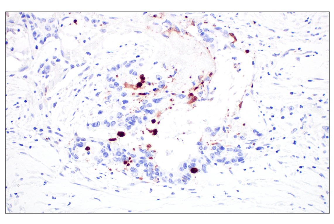 Immunohistochemistry Image 4: Cleaved Caspase-3 (Asp175) (D3E9) Rabbit Monoclonal Antibody