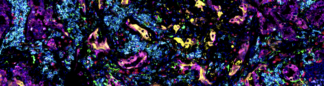 Immunohistochemical analysis of paraffin-embedded human lung carcinoma using PD-L1 (E1L3N™) XP® Rabbit mAb.
