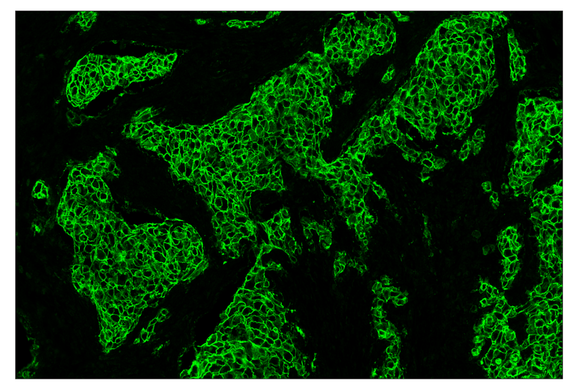 Immunohistochemistry Image 2: HER2/ErbB2 (D8F12) & CO-0059-647 SignalStar<sup>™</sup> Oligo-Antibody Pair