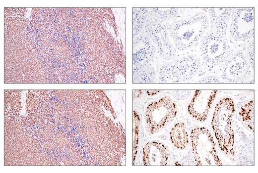 Immunohistochemistry Image 4: SS18-SSX (E9X9V) XP<sup>®</sup> Rabbit mAb