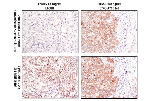 Immunohistochemistry Image 1: EGF Receptor (E746-A750del Specific) (D6B6) XP<sup>®</sup> Rabbit mAb (BSA and Azide Free)