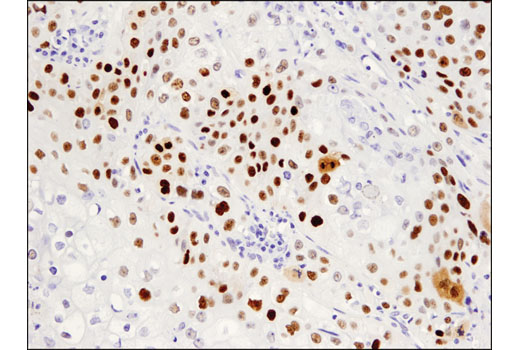 Immunohistochemistry Image 3: p53 (DO-7) Mouse Monoclonal Antibody (BSA and Azide Free)