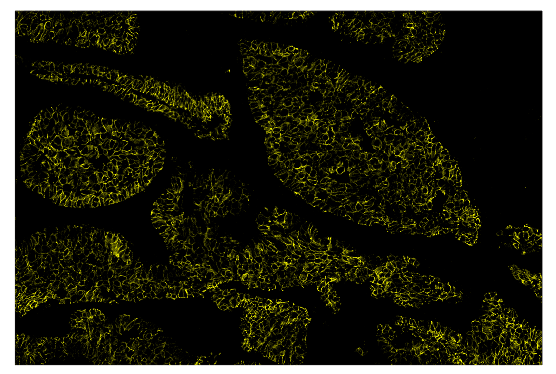 Immunohistochemistry Image 3: E-Cadherin (24E10) & CO-0103-647 SignalStar<sup>™</sup> Oligo-Antibody Pair