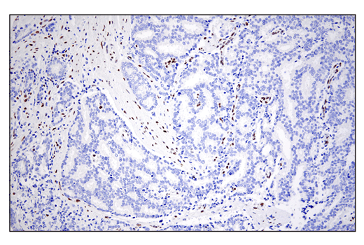 Immunohistochemistry Image 2: ZEB1 (E2G6Y) XP<sup>®</sup> Rabbit mAb (BSA and Azide Free)