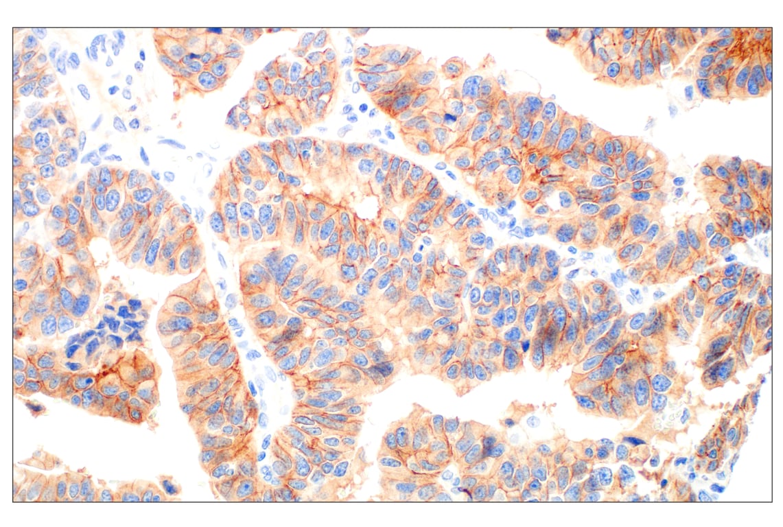 Immunohistochemistry Image 3: HER3/ErbB3 (D22C5) Rabbit Monoclonal Antibody (BSA and Azide Free)