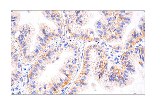 Immunohistochemistry Image 3: HER2/ErbB2 (D8F12) Rabbit Monoclonal Antibody