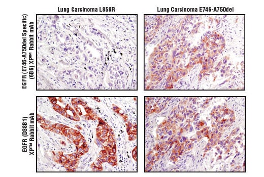 Immunohistochemistry Image 2: EGF Receptor (E746-A750del Specific) (D6B6) Rabbit Monoclonal Antibody (BSA and Azide Free)