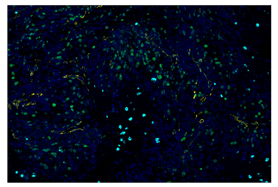 Immunohistochemistry Image 2: MMP-9 (D6O3H) & CO-0142-647 SignalStar<sup>™</sup> Oligo-Antibody Pair