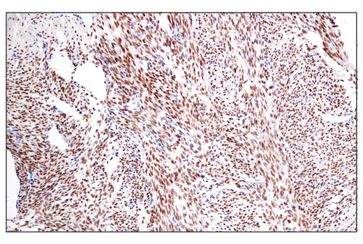 Immunohistochemistry Image 1: SS18-SSX (E9X9V) Rabbit Monoclonal Antibody