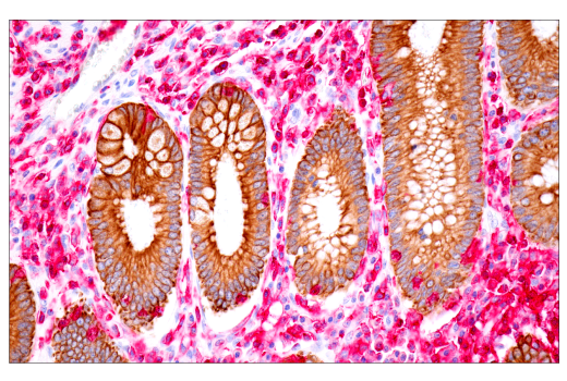 Immunohistochemistry Image 2: SignalStain<sup>®</sup> IHC Dual Staining Kit (AP, Rabbit, Red / HRP, Mouse, Brown)