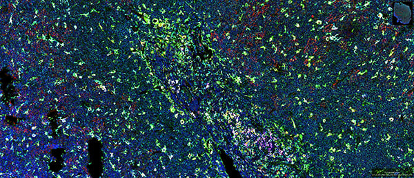 SignalStar multiplex immunohistochemical analysis of paraffin-embedded human non-Hodgkin’s lymphoma.