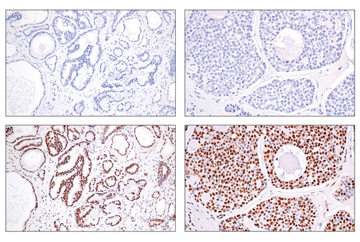 Immunohistochemistry Image 3: SS18-SSX (E9X9V) Rabbit Monoclonal Antibody (BSA and Azide Free)