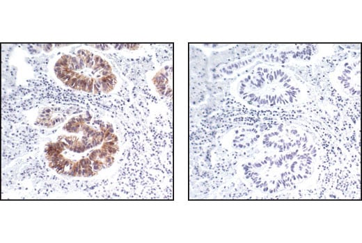 Immunohistochemistry Image 3: Phospho-HER2/ErbB2 (Tyr1221/1222) (6B12) Rabbit Monoclonal Antibody (BSA and Azide Free)