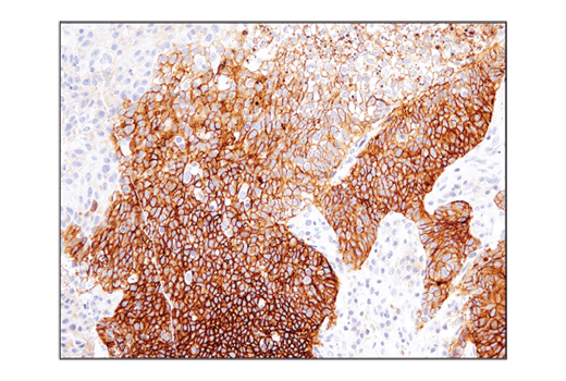 Immunohistochemical analysis of paraffin-embedded human urothelial carcinoma using CD47 ( D3O7P ) Rabbit mAb performed on the BOND RX Fully Automated Research Stainer by Leica Biosystems.