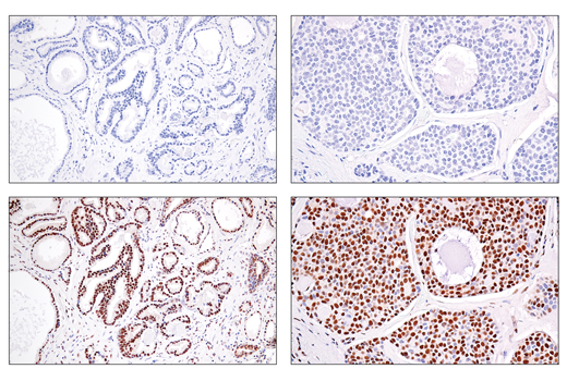 Immunohistochemistry Image 2: SS18-SSX (E9X9V) XP<sup>®</sup> Rabbit mAb