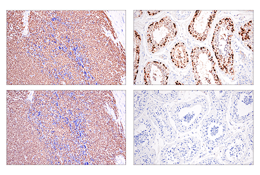 Immunohistochemistry Image 4: SSX (E5A2C) Rabbit Monoclonal Antibody (Carboxy-terminal Antigen)