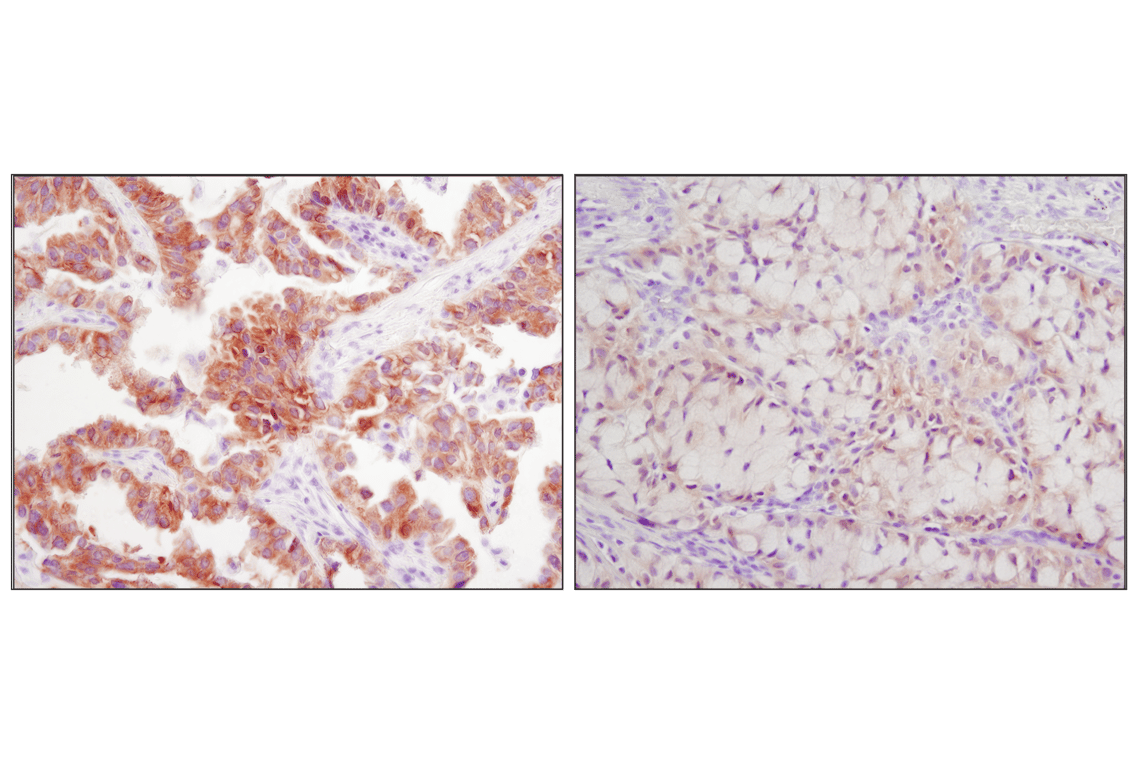 Immunohistochemistry Image 3: ALK (D5F3) Rabbit Monoclonal Antibody