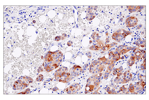Immunohistochemical analysis of paraffin-embedded human ductal breast carcinoma using Cleaved Gasdermin D (Asp275) (E7H9G) Rabbit mAb.