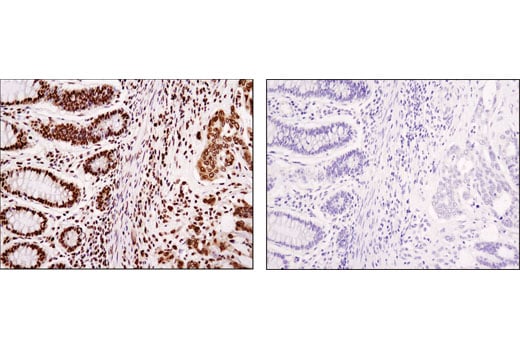 Immunohistochemistry Image 2: HMGA1 (D4F8) Rabbit Monoclonal Antibody