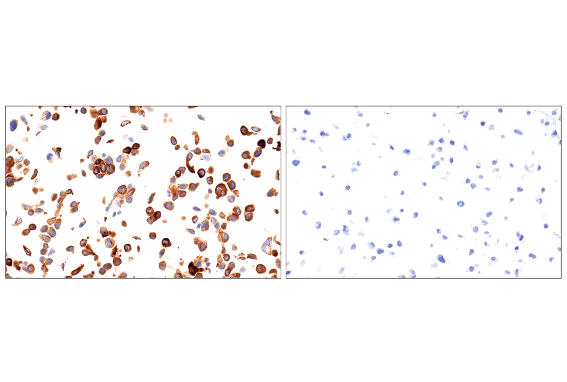 Immunohistochemistry Image 2: ROS1 (D4D6) Rabbit Monoclonal Antibody (Autostainer Formulated)