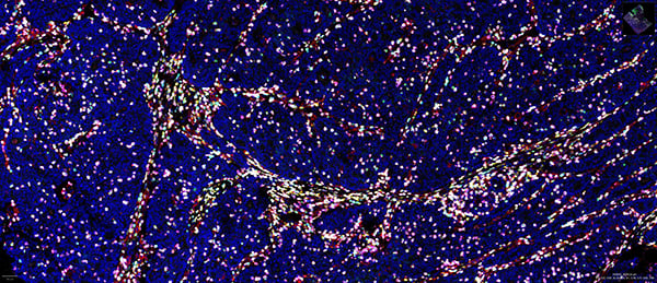 SignalStar multiplex immunohistochemical analysis of paraffin-embedded human colorectal adenocarcinoma.