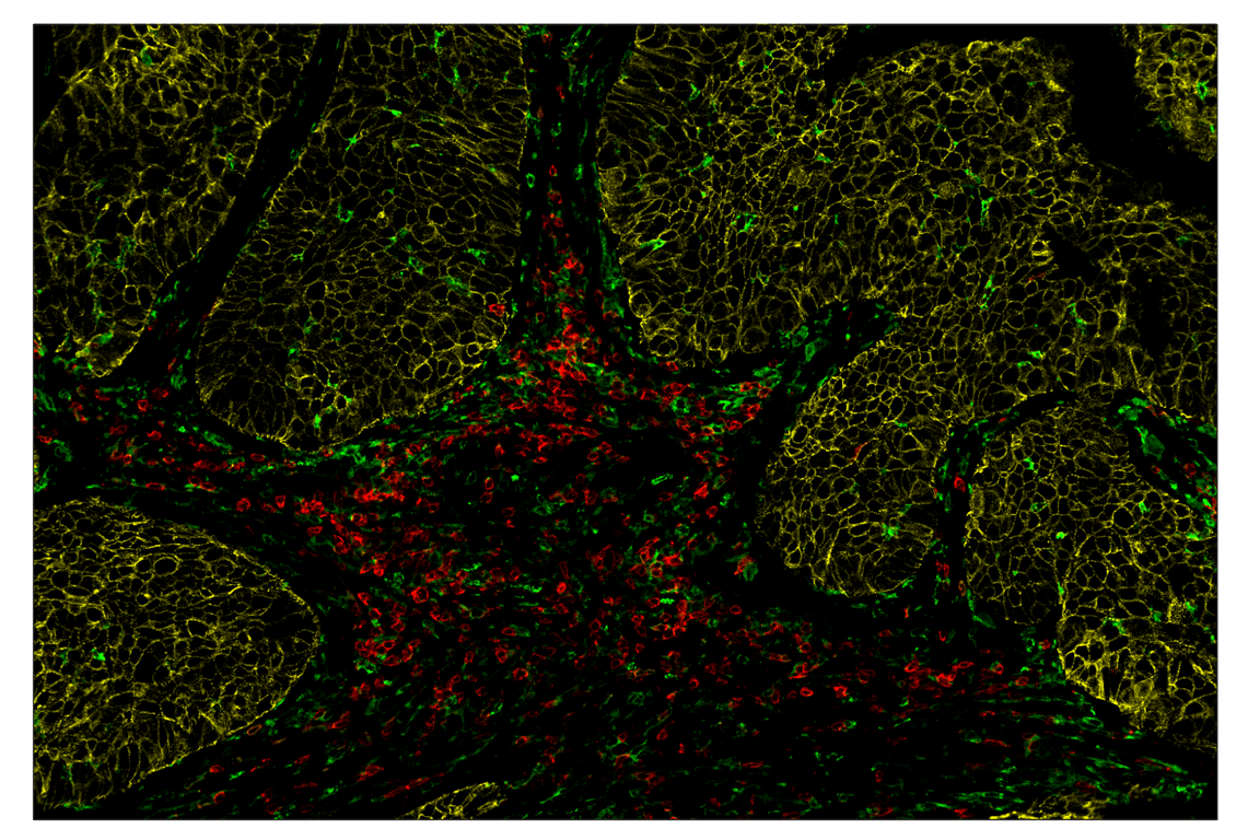 Immunohistochemistry Image 1: E-Cadherin (24E10) & CO-0103-647 SignalStar<sup>™</sup> Oligo-Antibody Pair