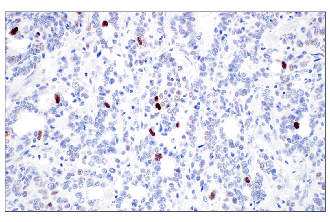 Immunohistochemistry Image 4: MDM2 (F7W7X) Rabbit Monoclonal Antibody (BSA and Azide Free)