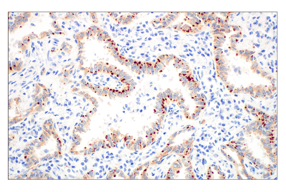 Immunohistochemistry Image 3: ROS1 (D4D6) Rabbit Monoclonal Antibody