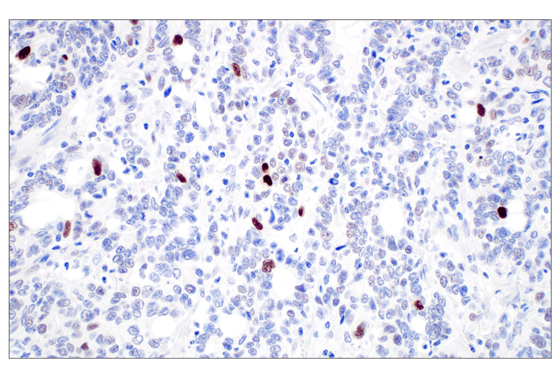 Immunohistochemistry Image 4: MDM2 (F7W7X) Rabbit Monoclonal Antibody (BSA and Azide Free)