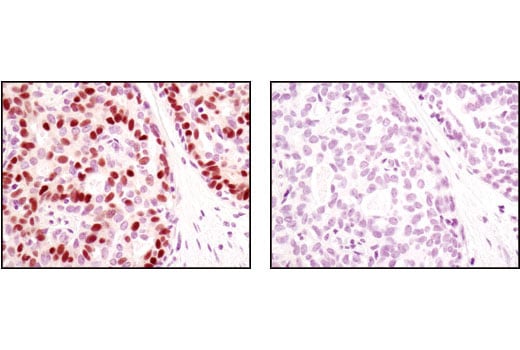 Immunohistochemistry Image 3: Progesterone Receptor A/B (C89F7) Rabbit Monoclonal Antibody
